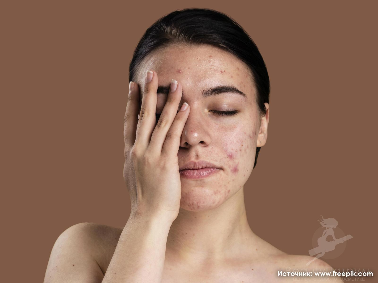 Как избавиться от мелкой бесцветной сыпи на лице?